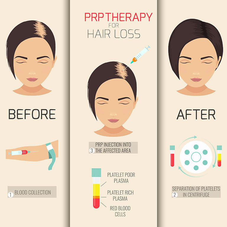 PRP-Women