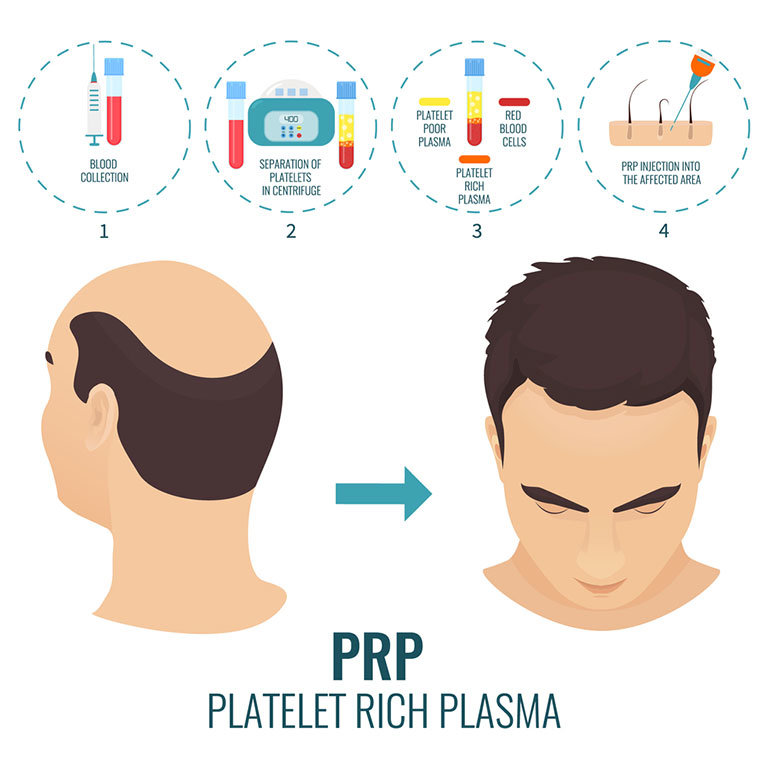 PRP-MEN